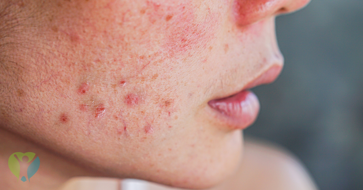 Como Clarear Manchas no Rosto Rápido? Dermatologistas Revelam os Segredos