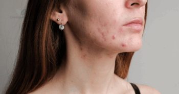 😱 Como Secar Espinhas Rápido: Métodos Caseiros, Dermatológicos e Produtos que Funcionam Mesmo!