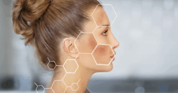 Como Tratar Melasma no Rosto: Guia Completo e Atualizado