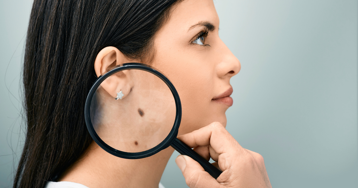 Saiba quais são os principais sintomas do câncer de pele, como identificar sinais de alerta e a importância do diagnóstico precoce para o tratamento eficaz.